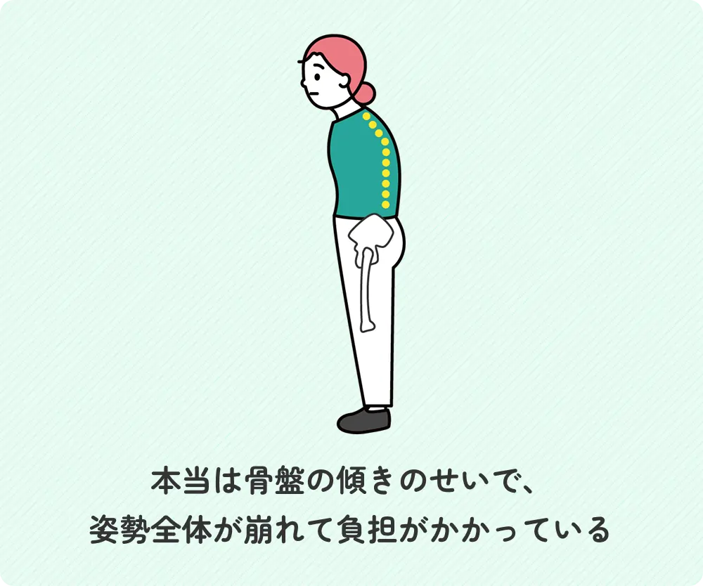 本当は骨盤の傾きのせいで、姿勢全体が崩れて負担がかかっている