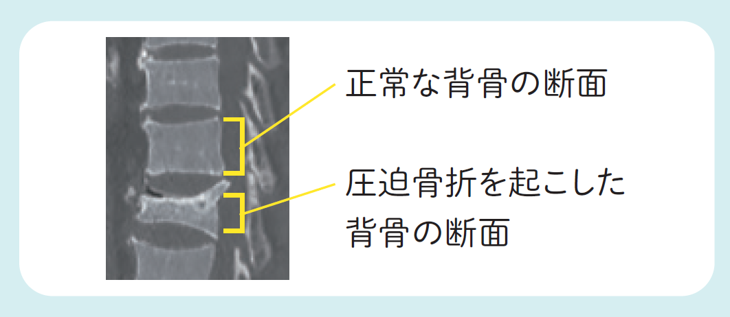 正常な背骨の断面と、圧迫骨折を起こした背骨の断面