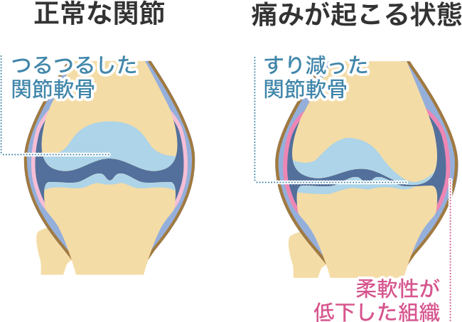 ひざ関節の正常な軟骨の状態と、痛みが起こってしまうすり減った状態のイメージ（ひざの痛みの原因は、ひざの周りの筋肉の衰えや柔軟性の低下が要因のひとつといわれています）