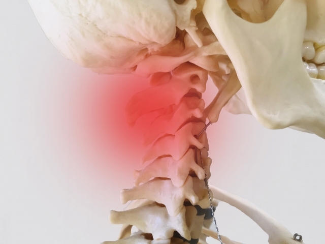 頚椎症のイメージ（頸椎や椎間板（7つある頸椎の骨の間で、クッションの役割をしている）が加齢とともに変化して、首が痛んだり、肩が張ったりする症状が出るものです）