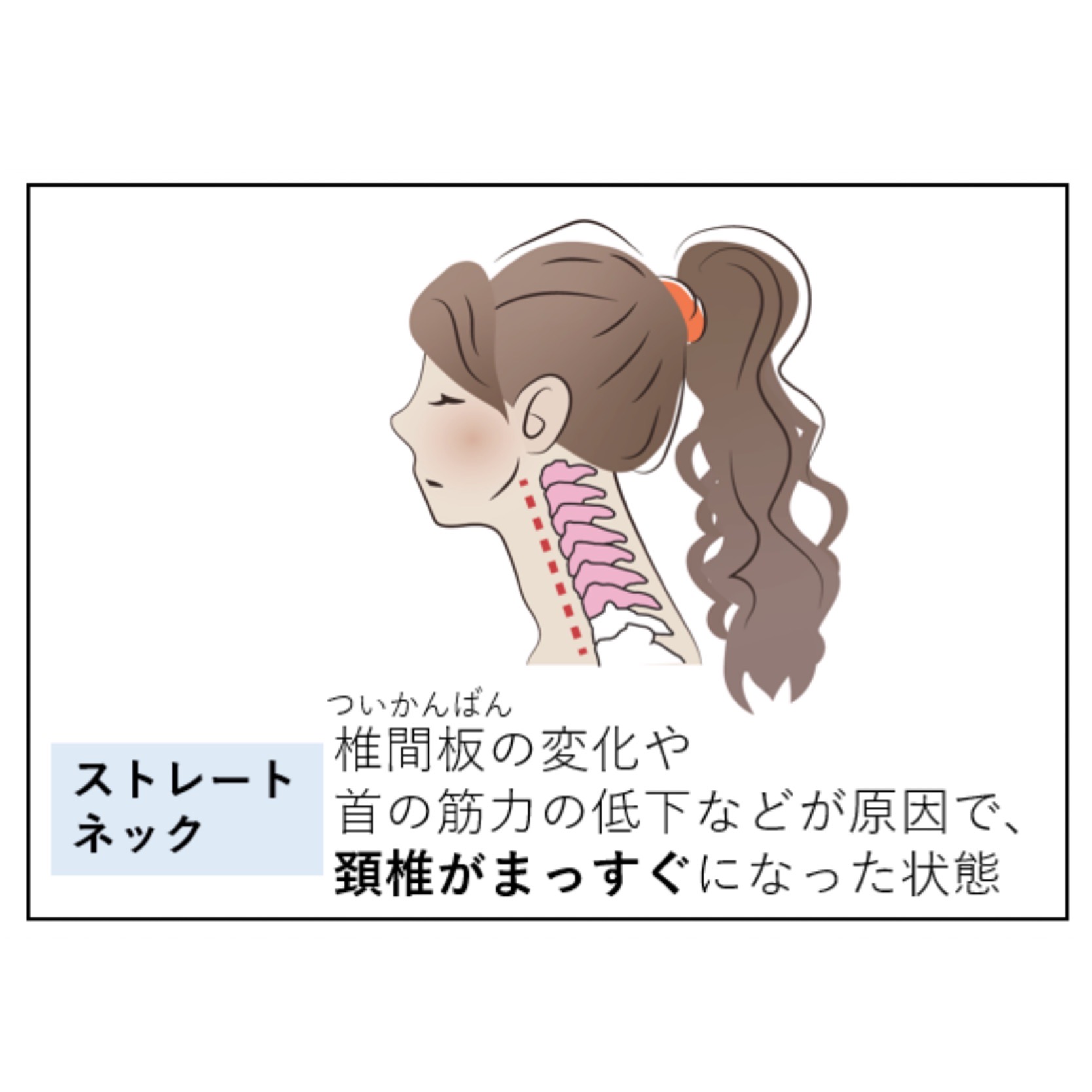 ストレートネック（椎間板の変化や、首の筋力の低下などが原因で、頸椎がまっすぐになった状態）