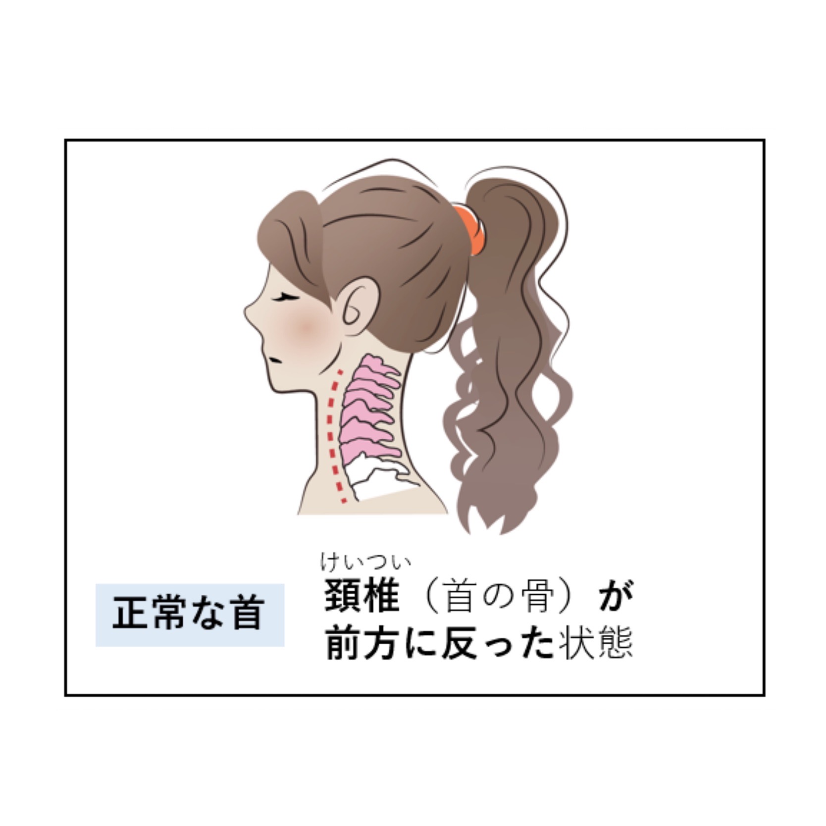 正常な首（頸椎（首の骨）が前方に反った状態）